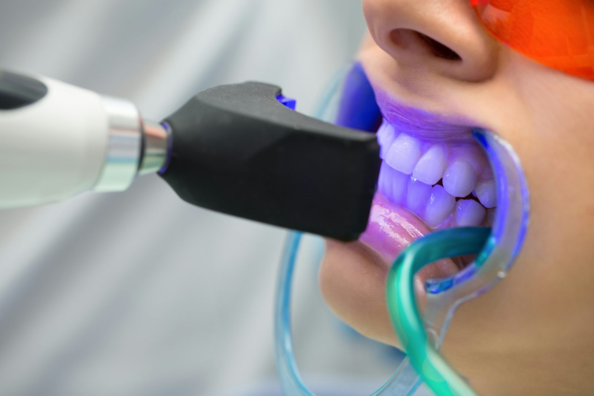 Is Teeth Whitening Safe for Sensitive Teeth?