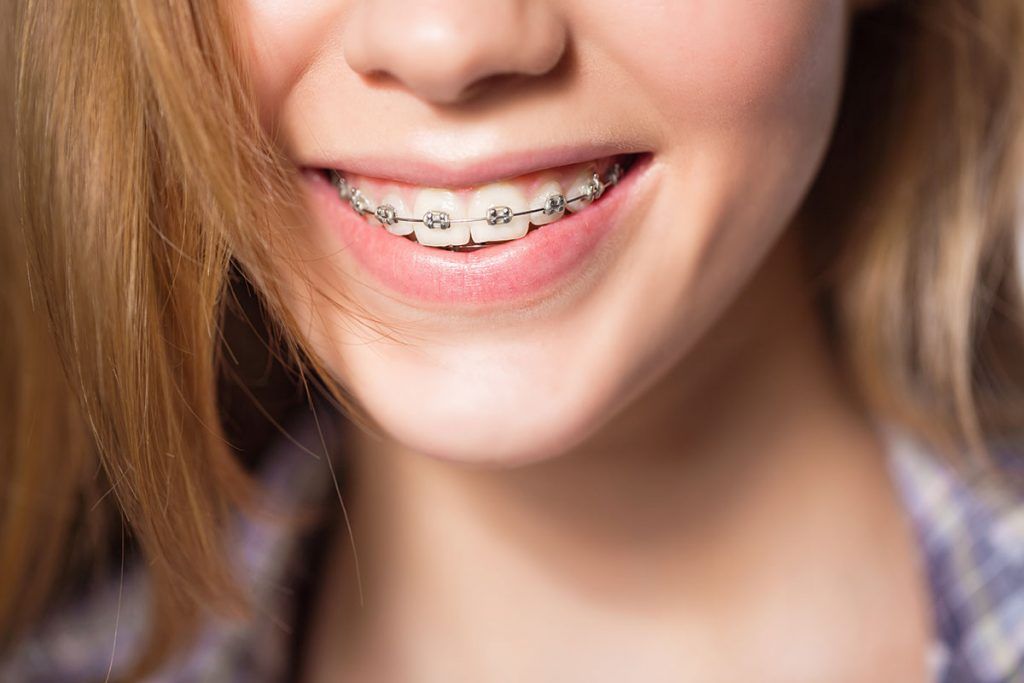 How Braces Correct Bite Problems and Teeth Alignment
